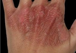 Burn Injury Attorney